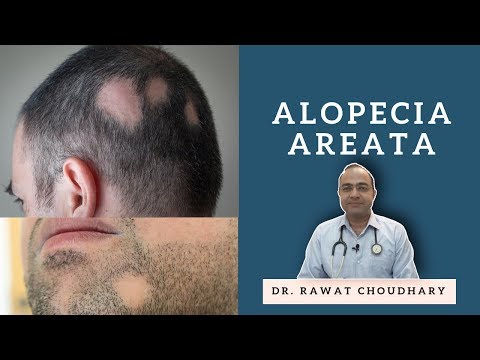 बाल झड़ना | गंजापन | Alopecia Areata | Baldness | Best Homeopathic Treatment