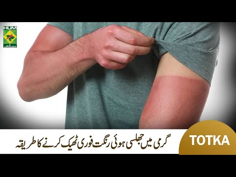 How To Remove Sun Tanning | Sun Burning Skin Treatment | SunBurn Home Remedy | MasalaTv