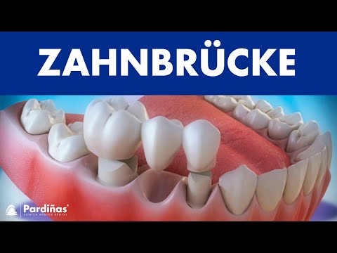 Zahnbrücke ©