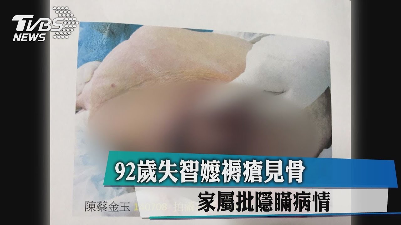 92歲失智嬤褥瘡見骨 家屬批隱瞞病情