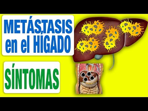 All the Symptoms of Liver Metastasis