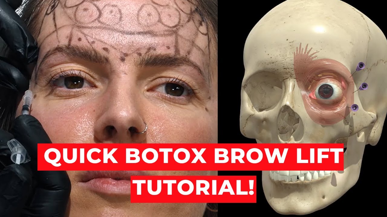 3D Botox BROW LIFT INJECTION TUTORIAL