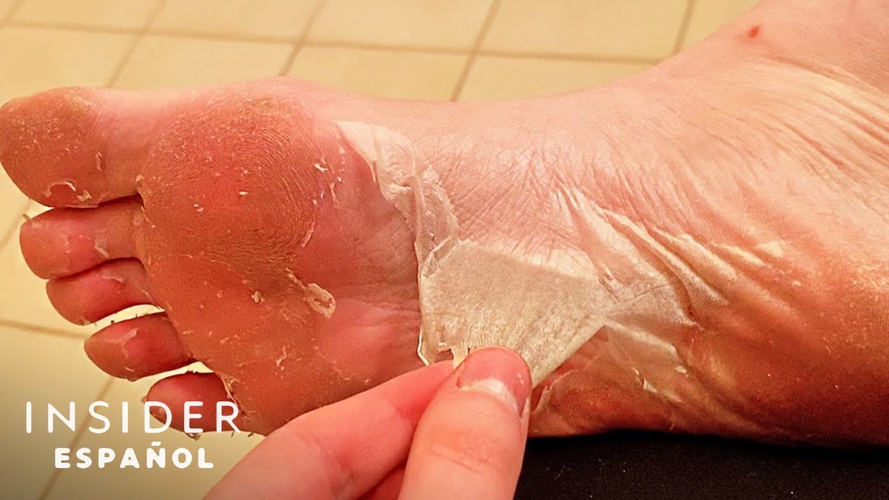 Mascarilla de pies elimina la piel muerta para dejarlos suaves como bebé | La solución a los granos