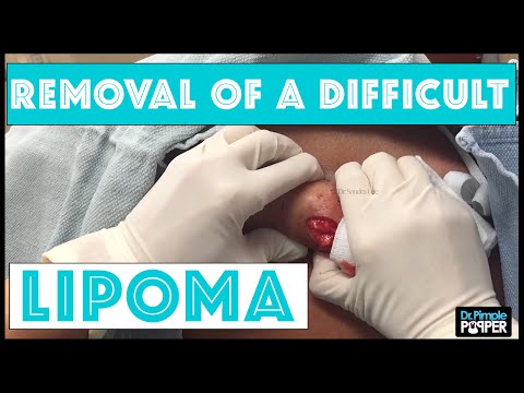 A lipoma nem féreg Lipóma (zsírdaganat) tünetei és kezelése - Pinworms a bőr alatt