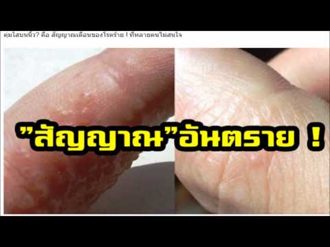 โรคสะเก็ดเงินจากจิตวิญญาณ ขี้ผึ้งโรคสะเก็ดเงินเจอร์เมเนียม