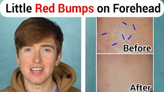How to Get Rid of Little Red Bumps on Forehead - Fungal Acne Malassezia