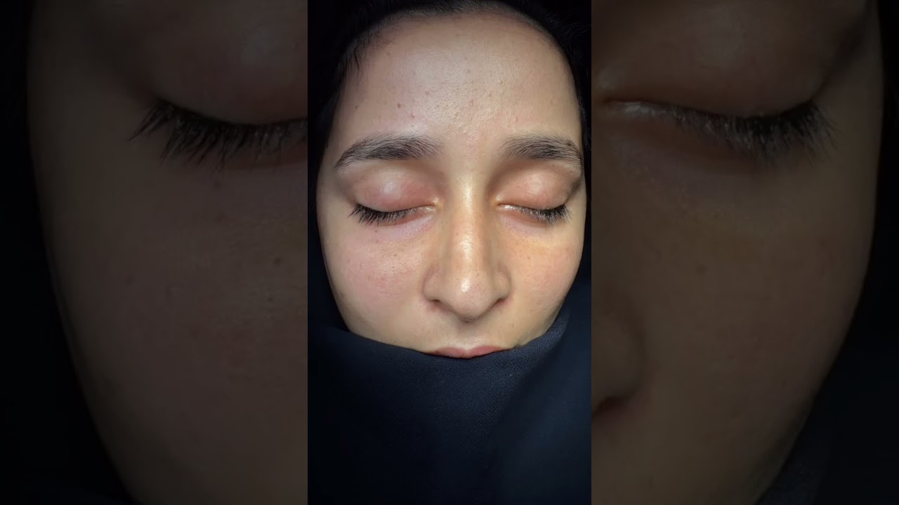 Revizyon Rinoplasti - Video 2