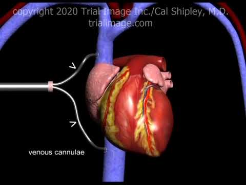 Cardiopulmonary Bypass (in 2 minutes) Animation by Cal Shipley, M.D.