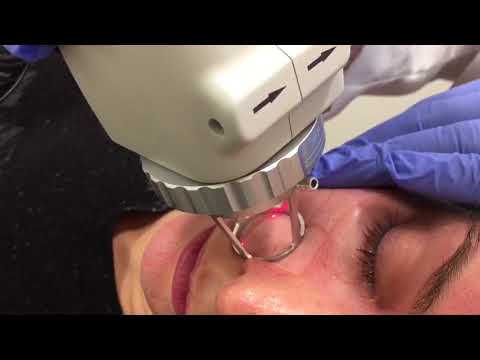 Fractional CO2 Laser Skin Resurfacing - Full Face!