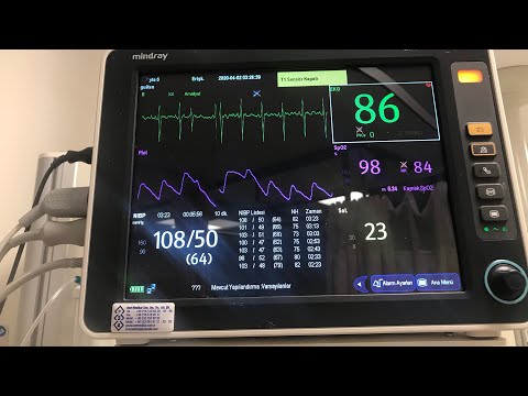 Genel Yoğun Bakımda Hasta Monitörizasyonu