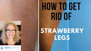 HOW TO GET RID OF STRAWBERRY LEGS | NATURALLY