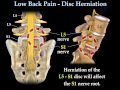 Low Back Pain - Disc Herniation ,Sciatica ...