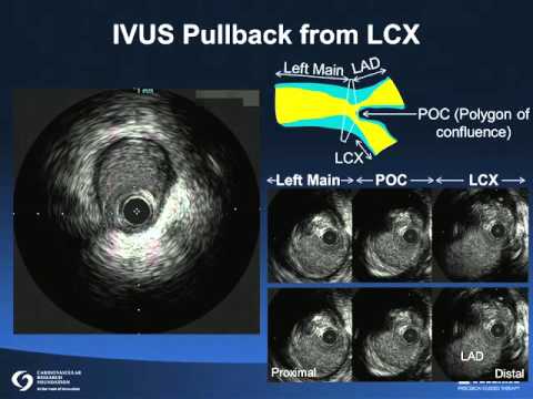 Evaluation of Left Main Stenosis
