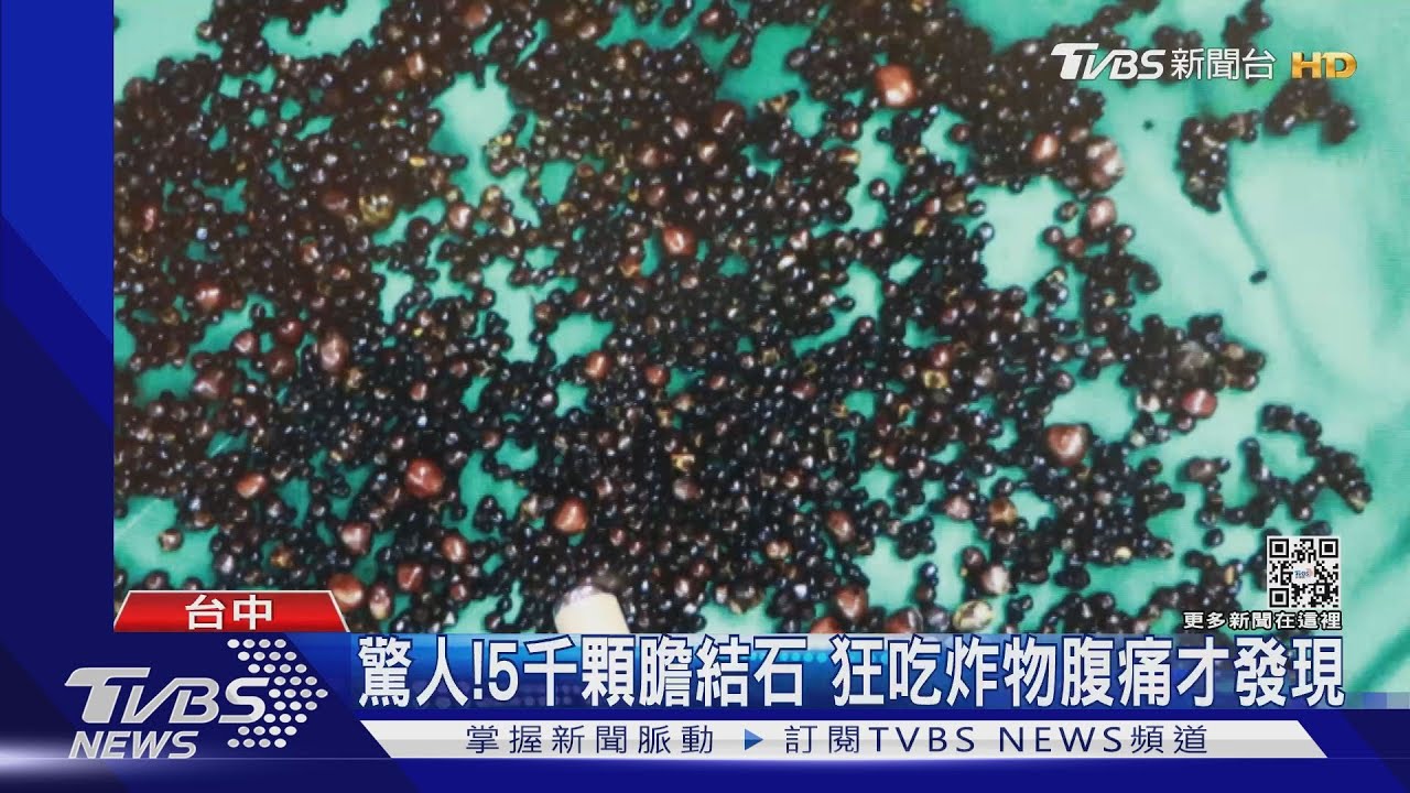 驚人!5千顆膽結石 狂吃炸物腹痛才發現