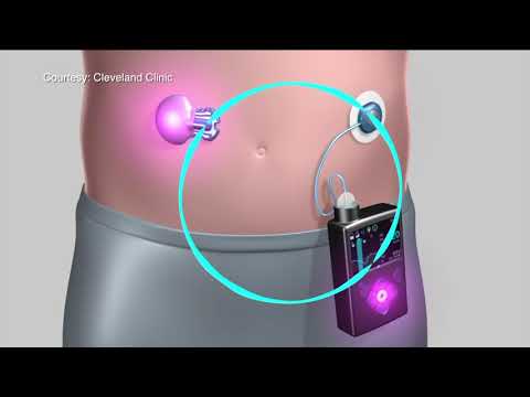 Der Geruch von Aceton in einem diabetischen Typ-2-Diabetes in der Behandlung von Frauen