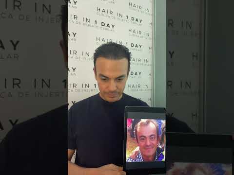 A New Chapter of Confidence: A Patient’s Journey for Hair Transplant in Guadalajara, Mexico at Hair in 1 Day