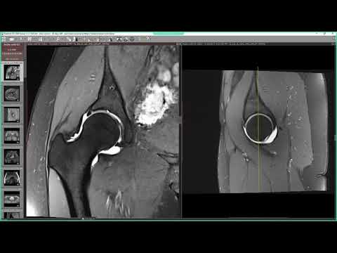 Unguente pentru osteochondroza articulației umărului. Osteocondroza