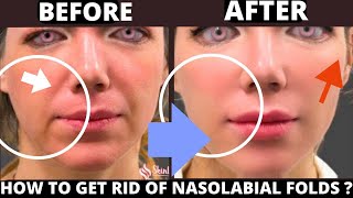 🛑 SMILE LINES FACIAL EXERCISES (NASOLABIAL FOLDS) | JOWSL | ANTI-AGING EXERCISES FOR WRINKLES