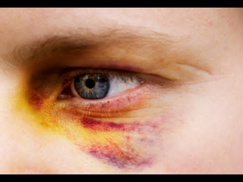 How to Get Rid of a Black Eye Fast - Black Eye...