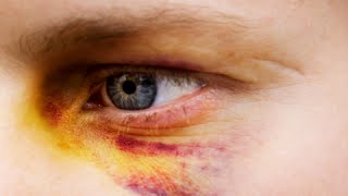 How to Get Rid of a Black Eye Fast - Black Eye Treatment