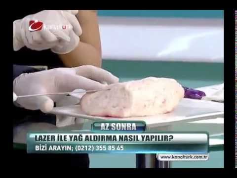 SmartLipo - Akıllı Lipo - Lazer lipoliz Op. Dr. Berker Büyükgüral