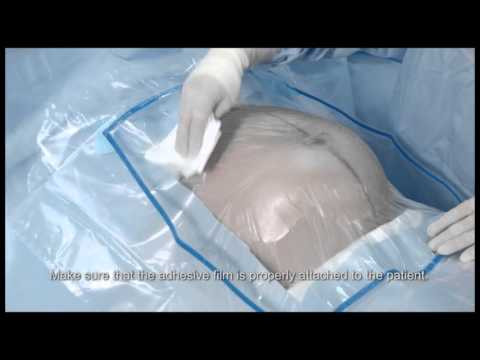 C-section Set Tutorial