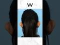 Pin your ears back to correct ear protrusion, position and shape with an Otoplasty procedure!