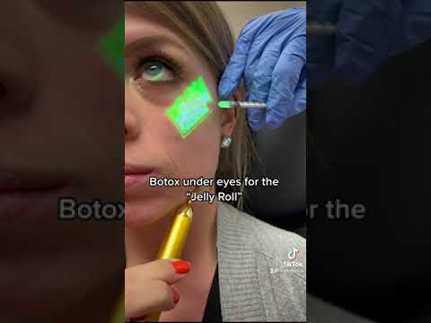 Botox for Jelly Roll