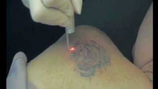 preview picture of video 'GRDP Laser Tattoo Removal, Skipton, North Yorks.'