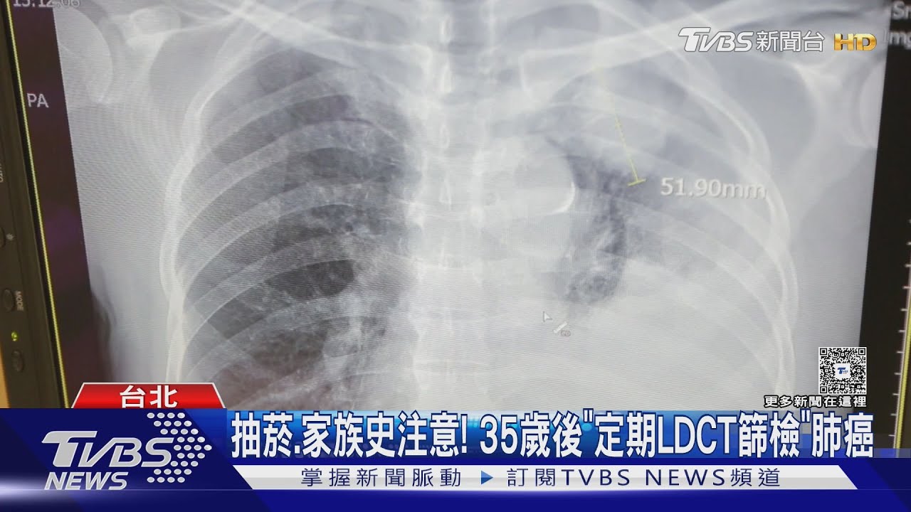 持續咳嗽、胸痛已3期後! 肺結節0期治癒率99%