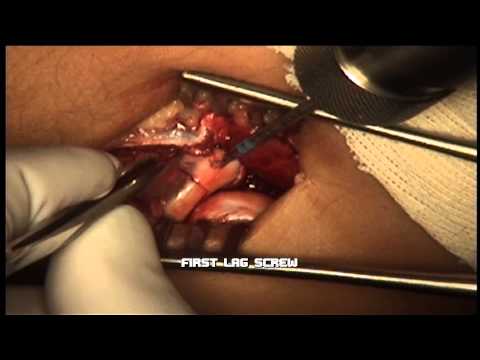 ORIF Intra-Articular Radial Head Fracture Surgery