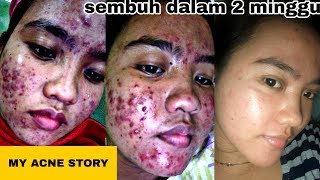 MY ACNE STORY |JERAWAT HILANG DALAM 1 BULAN by Mawar ♥️