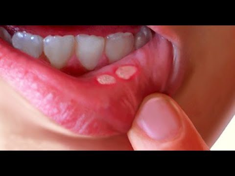 Uncover the 9 Signs You May Have a Vitamin B2 Deficiency!