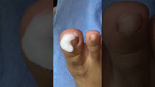 Ep_8842  Foot nails skin removal 👣 น้องโดน 4 มุม  😅 (clip from Thailand)