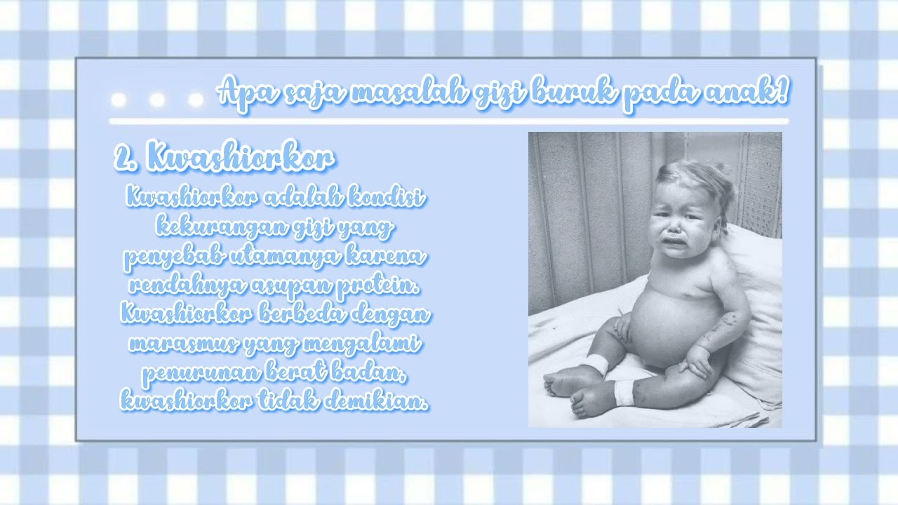 Penyuluhan Gizi Buruk Pada Balita