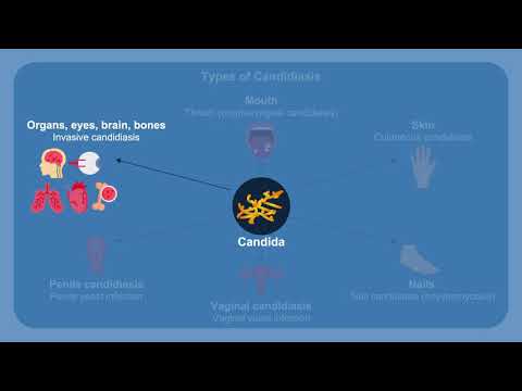 Overcoming Challenges in the Diagnosis and Treatment of Invasive Fungal Infections