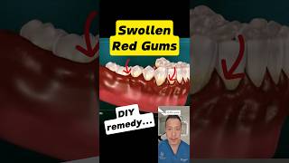 Download lagu Gusi Merah dan Sakit? Atasi dengan 3 Langkah Mudah! #dentallan #doktergigi #celanapendek mp3 Download lagu Gusi Merah dan Sakit? Atasi dengan 3 Langkah Mudah! #dentallan #doktergigi #celanapendek mp3