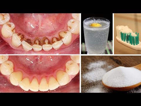 How To Remove Plaque From Teeth At Home Naturally