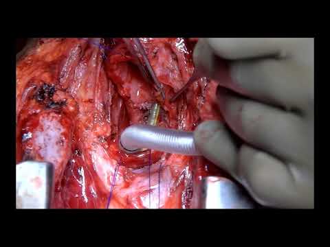 POST OESOPHAGECTOMY TRACHEO GASTRIC FISTULA REAPAIR WITH OMENTUM