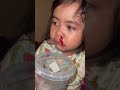 Anak Kecil Panas Tinggi Dan Mimisan