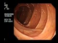 Colonoscopy Demonstrating a Moving Worm | NEJM