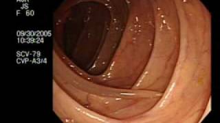 Colonoscopy Demonstrating a Moving Worm | NEJM