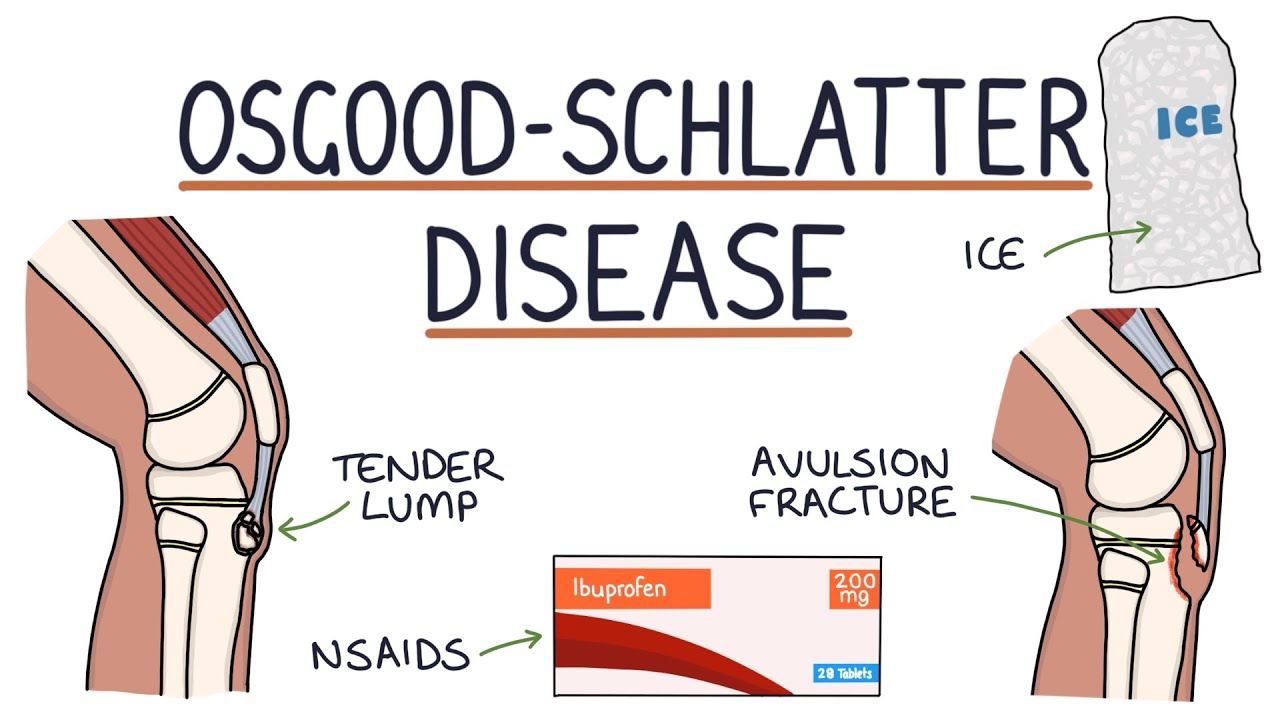 Is OsgoodSchlatter disease serious? Tipseri