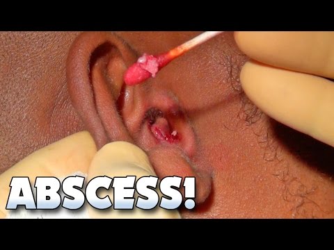 an abscess inside the ear?