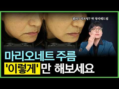 마리오네트 주름과 불둑살 없애는 피부과 시술 총정리