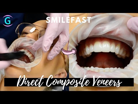 Direct Composite Veneers | SMILEFAST TRANSFORMATION!