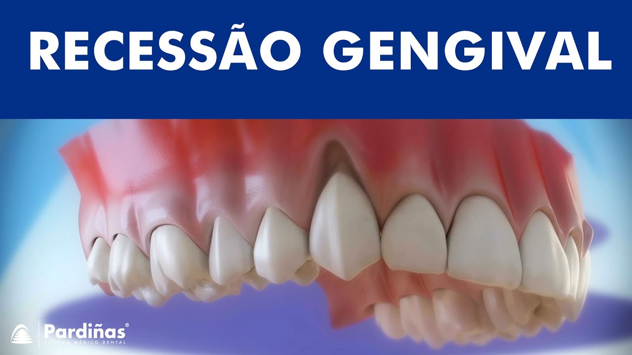 Recessão gengival - Tratamento da retração da gengiva ©
