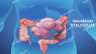 Colonic Volvulus #Volvulus #VolvulusAwareness #shorts #viral