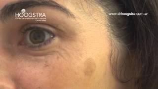 Manchas oscuras de la cara - Tratamiento con Láser Helios II (14032)