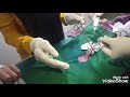 Khitan Metode Lem Super Fine Sealer Tidak Dijahit Tidak Ada Alat Yg Menempel